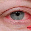 درمان قرمزی و خارش چشم
